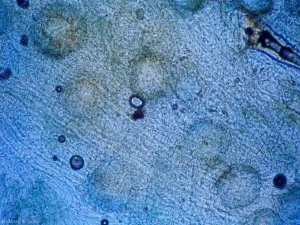 Aspect de fructification de  <b><i>Didymella bryoniae</i></b> en cours de formation dans des tissus affétés. (forme téléomorphe)(pourriture noire, black rot)