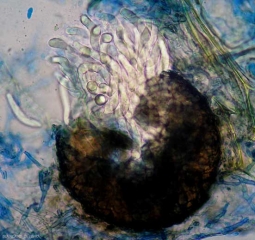 Aspect d'un périthèce de <b><i>Didymella bryoniae</i></b>, après l'avoir pressé, des asques immatures s'en échappent. (forme téléomorphe)(pourriture noire, black rot)