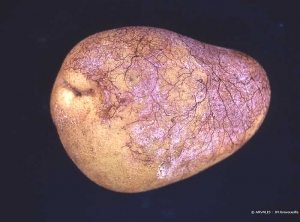 Tubercule de pomme de terre atteint de rhizoctone violet (<i><b>Rhizoctonia crocorum</i></b>), porteur de filaments mycéliens violacés et évoluant en pourriture